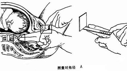 坐骨切迹宽度怎么测量图片